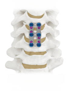 XTEND\u00ae Anterior Cervical Plate Final Construct